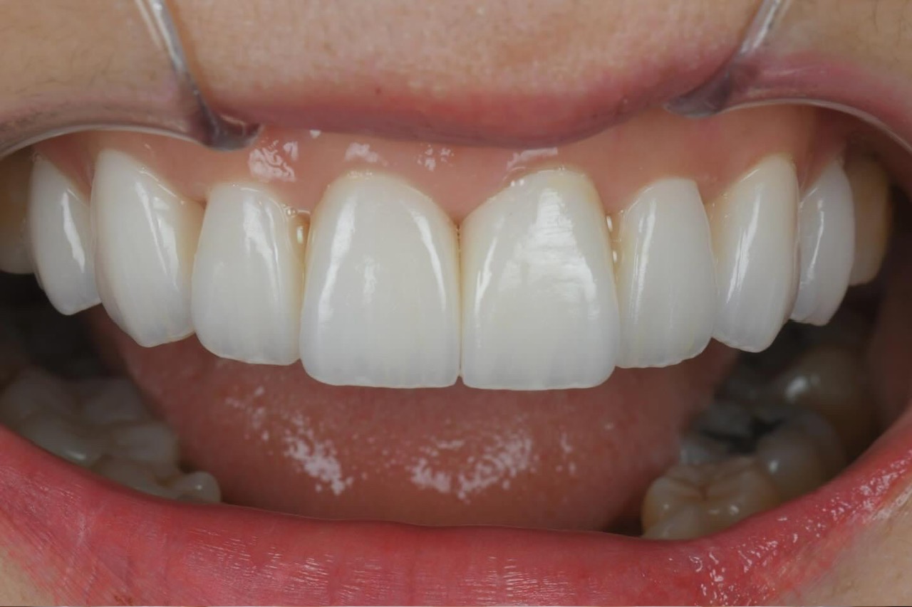 Mẫu phục hình răng sứ 14