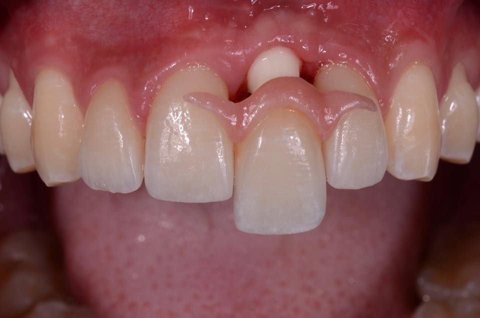 Mẫu phục hình răng sứ 2