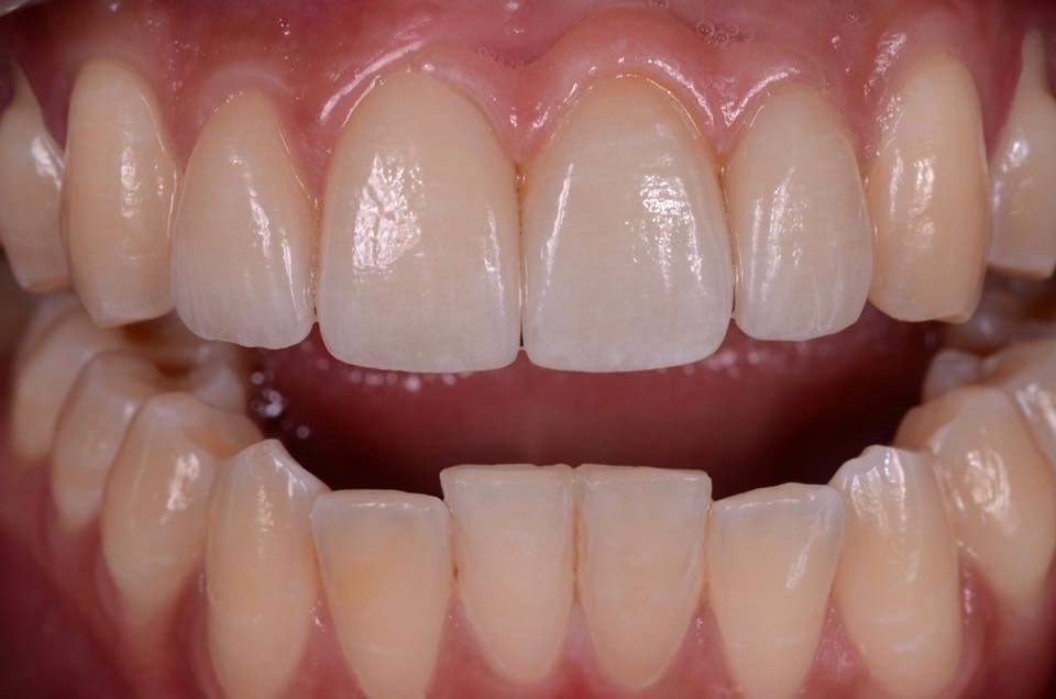 Mẫu phục hình răng sứ 3
