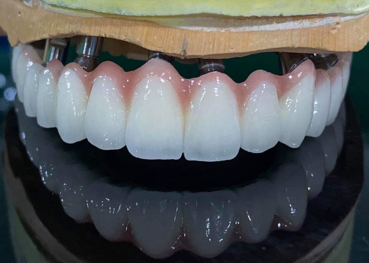 Mẫu phục hình răng sứ 5