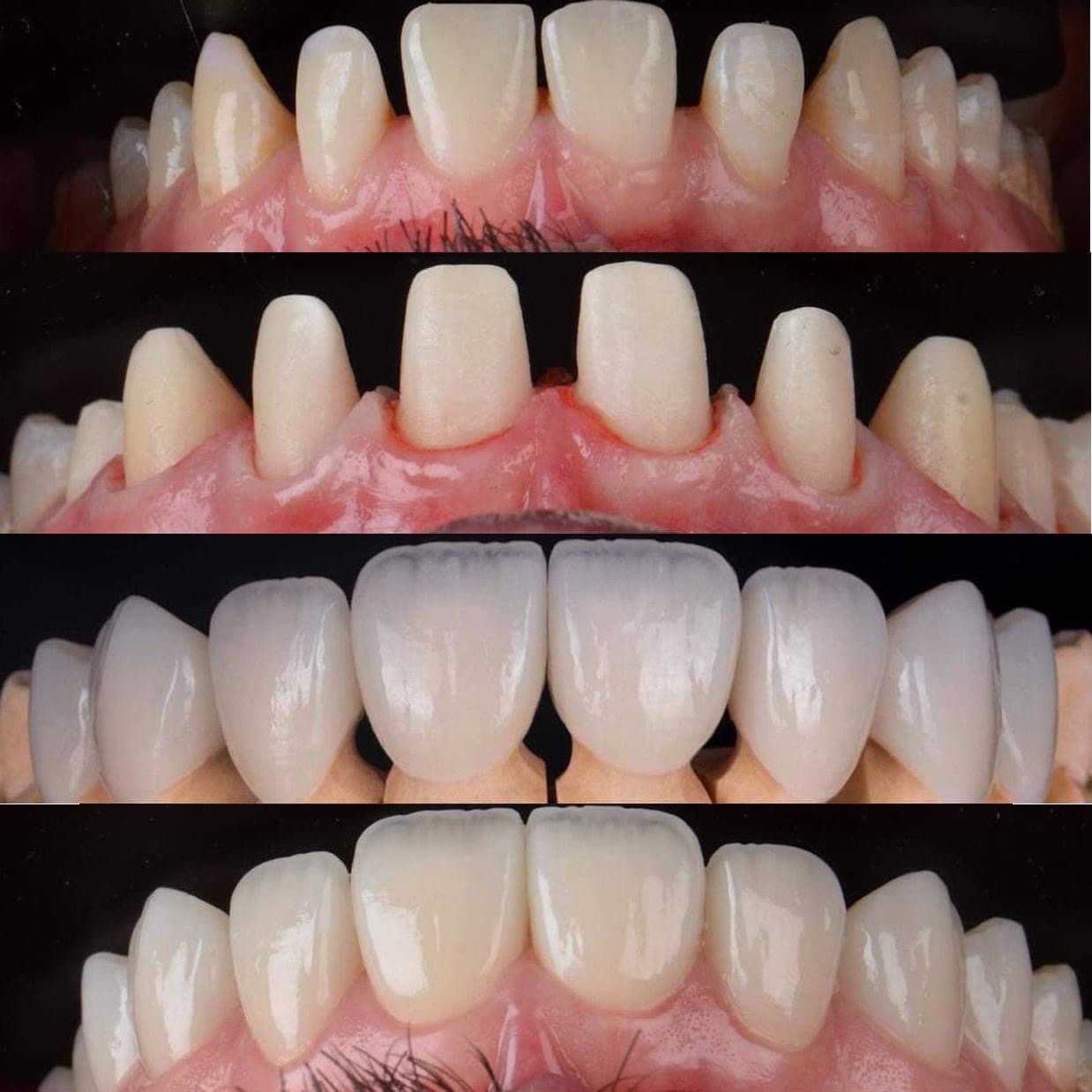 Mẫu phục hình răng sứ 6