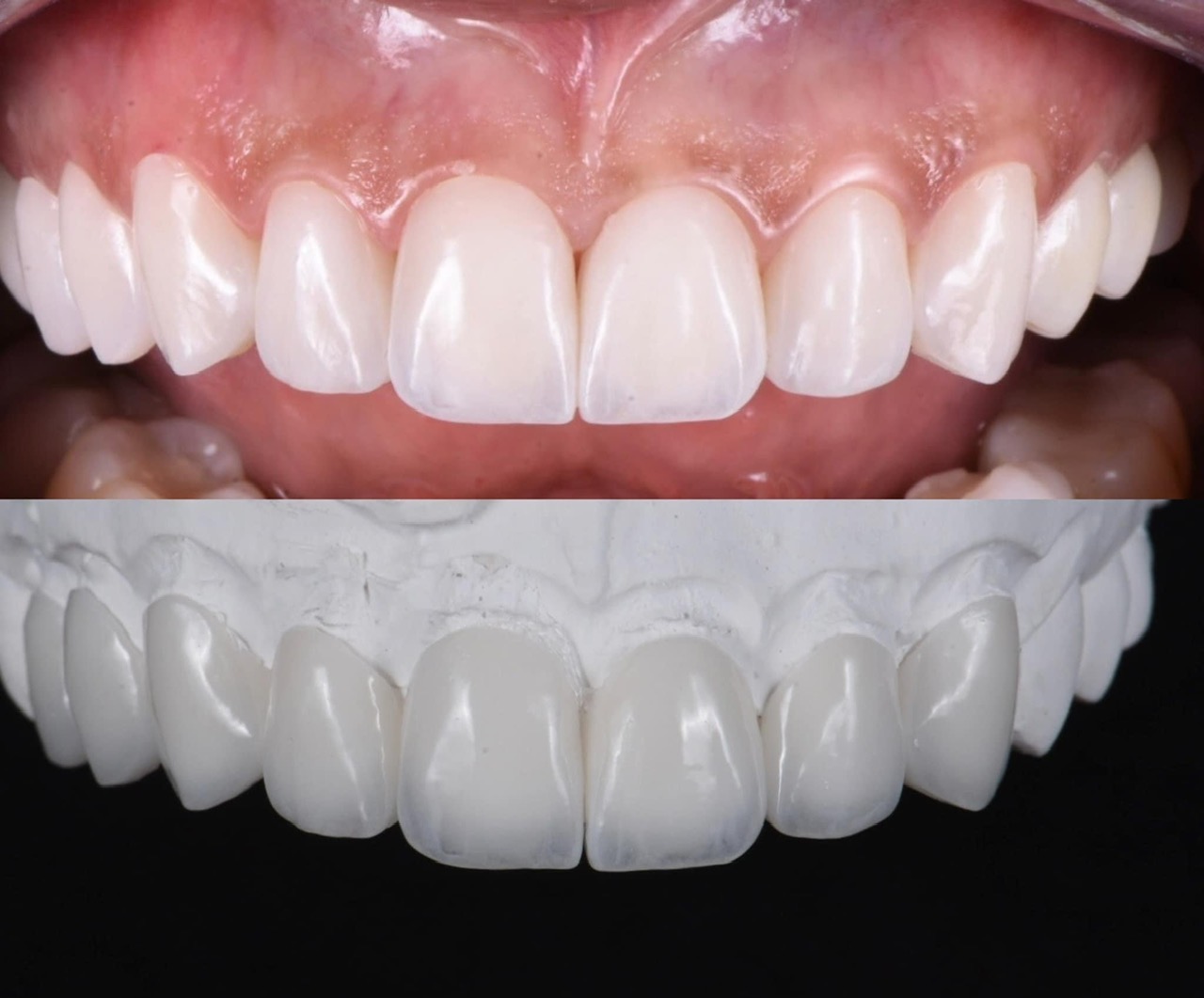 Mẫu phục hình răng sứ 7