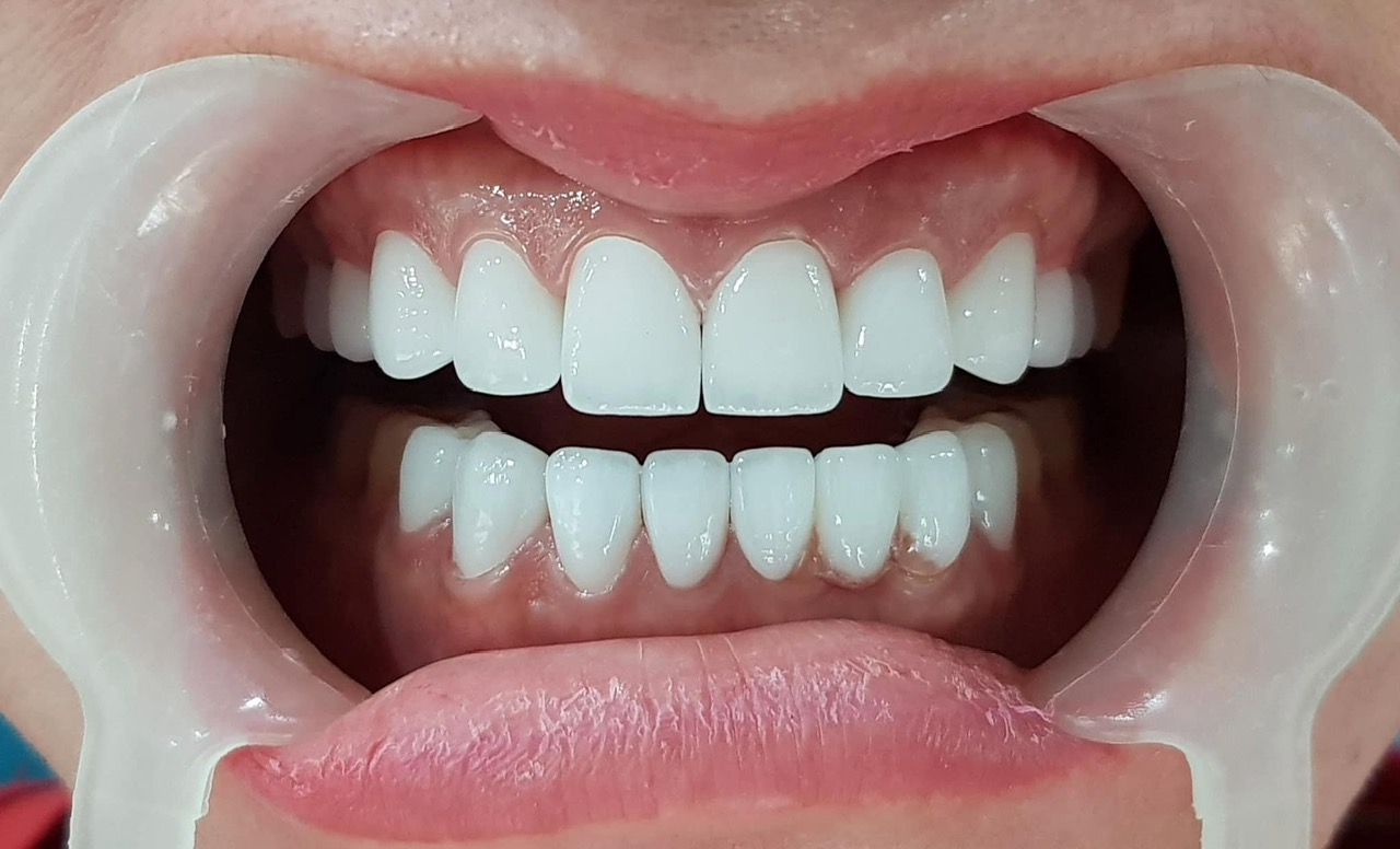 Mẫu phục hình răng sứ 8