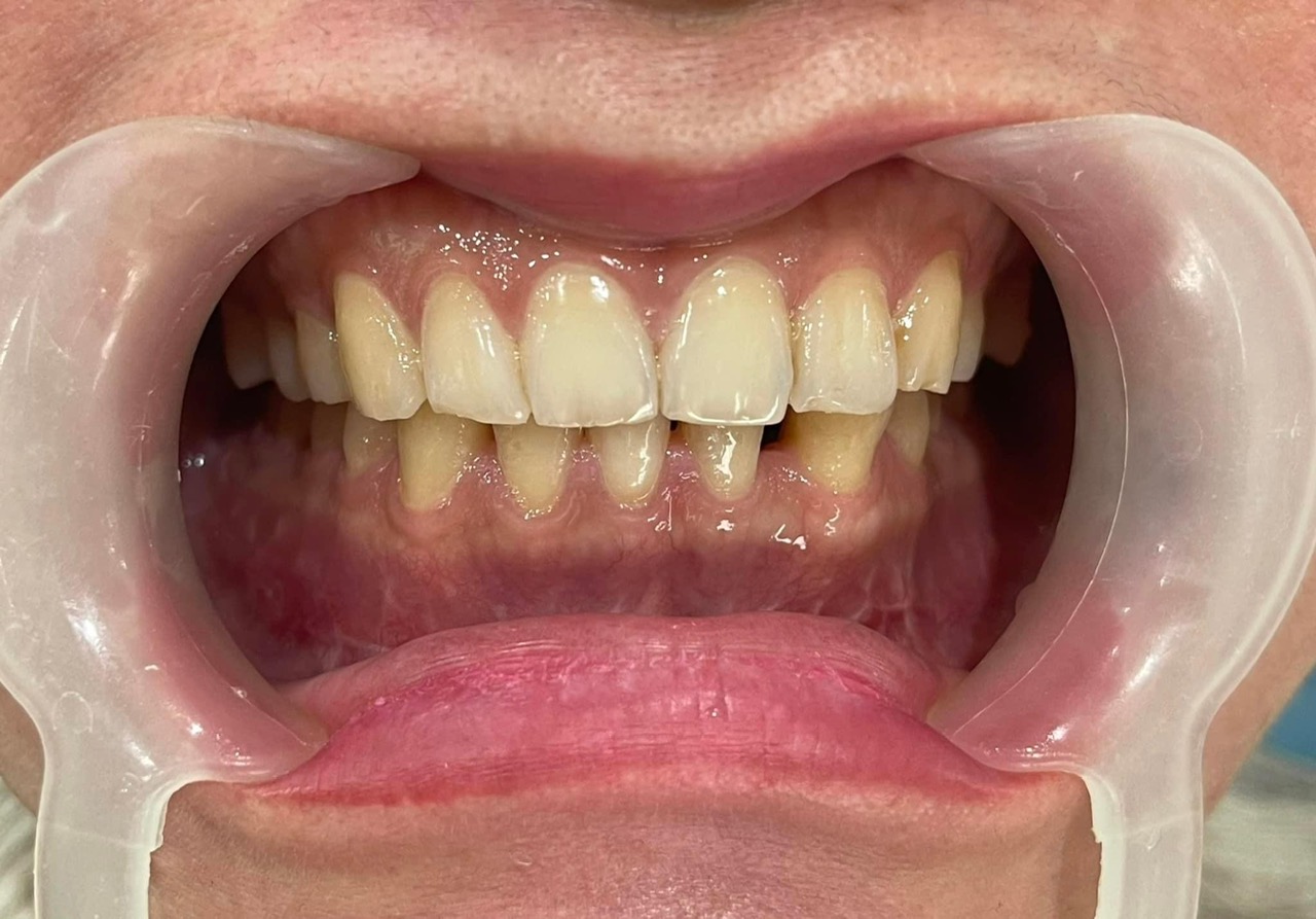Mẫu phục hình răng sứ 9